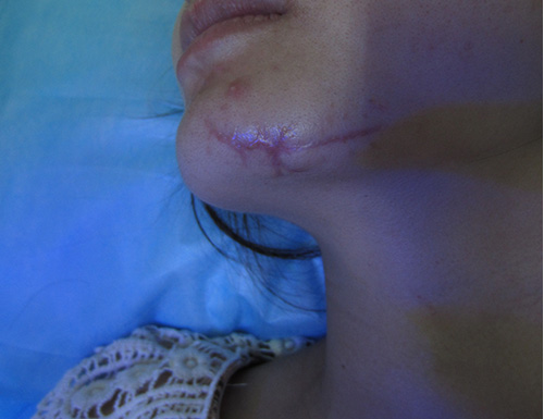 车祸造成脸上疤痕怎么去除