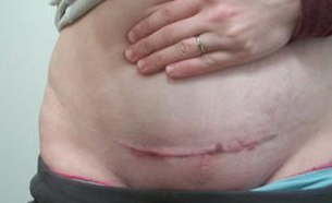 疤痕增生治疗多少钱