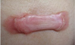 广州去疤痕医院