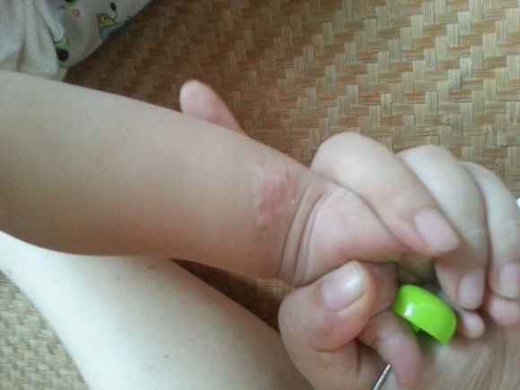 广药三院疤痕科