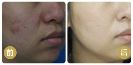 去疤痕价格一般多少钱