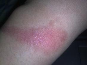 色素疤痕怎么去除?