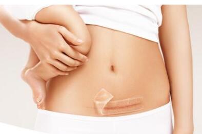 破腹产疤痕