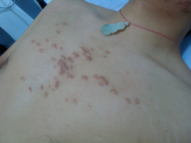 广药三院疤痕科